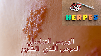 HERPES