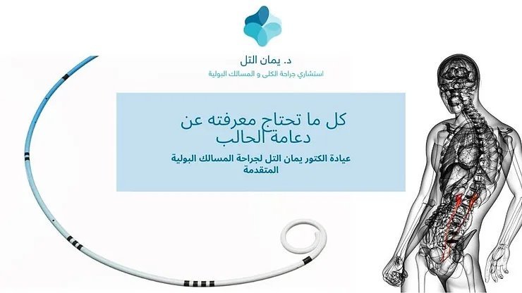 دعامة الحالب و اعراضه و ازالتها