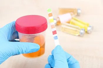 دلالات لون البول: تغير لون البول وعلى ماذا يدل؟