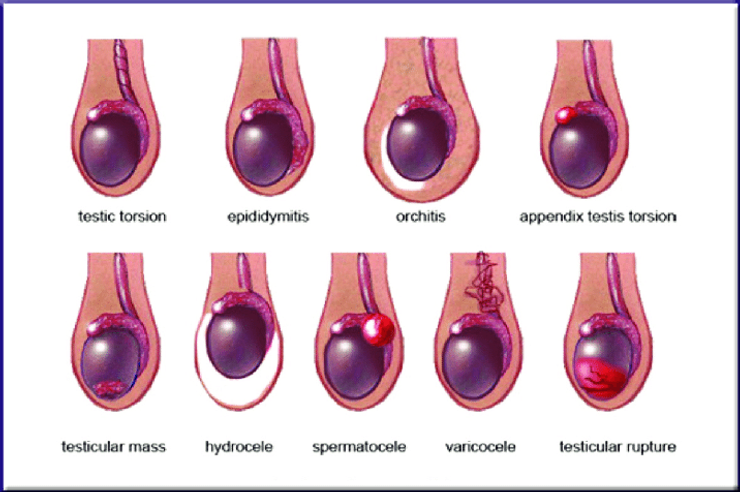 تكتلات كيس الصفن: هل هي سرطانية دائماً؟ أسباب وعلاج كتل كيس الصفن
