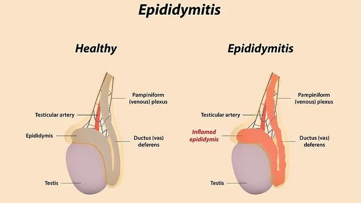 epididymitis