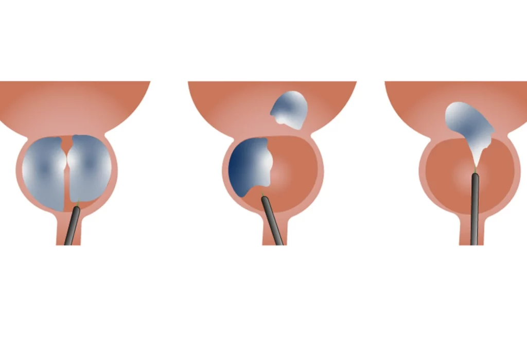 التقشير بالليزر