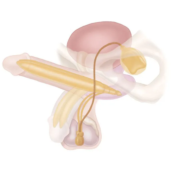 عملية دعامة الانتصاب