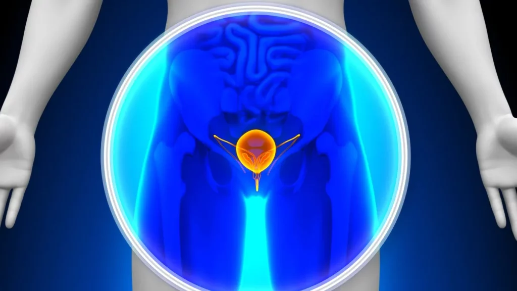 سرطان المثانة