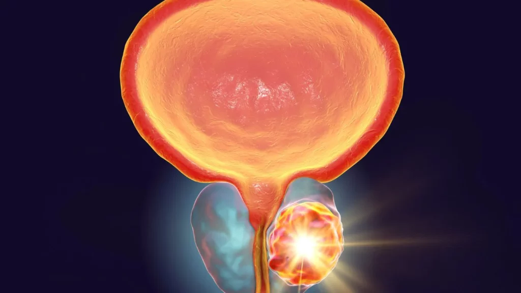 علاج تضخم البروستات