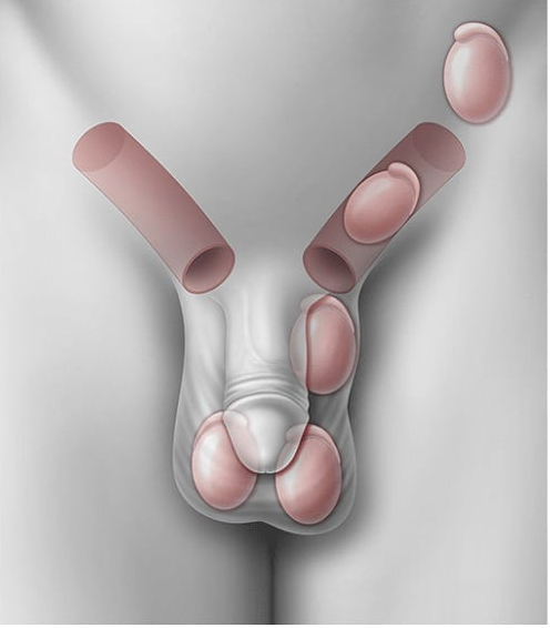 الفرق بين الخصية المعلقة والخصية النطاطة لدى الأطفال