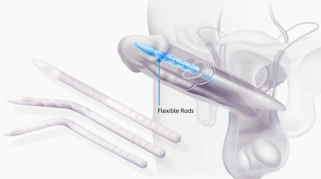 الدعامة السيليكونية (القابلة للثني)