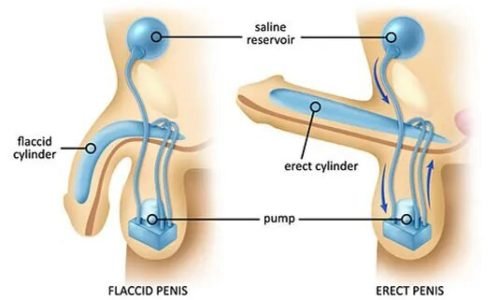 زراعة الدعامة الهيدروليكية
