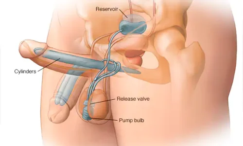 تكلفة زراعة دعامة الانتصاب في جدة