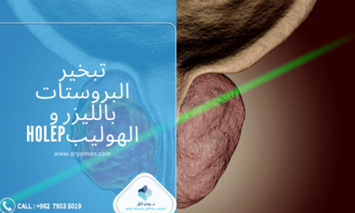 تبخير البروستات بالليزر و الهوليبHOLEP