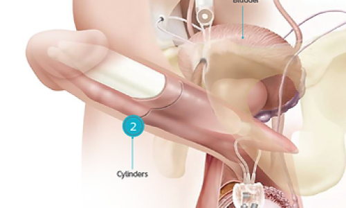 يزرع الانتصاب