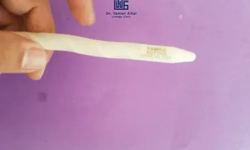 تكلفة عملية دعامات القضيب في الاردن, اهم ١٠ أمور يجب أن يعرفها المريض