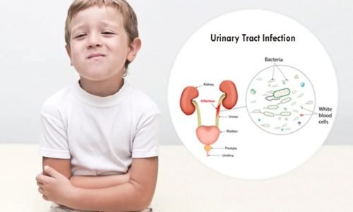 عوامل ترفع من خطر حدوث الارتجاع البولي الحالبي لدى الأطفال