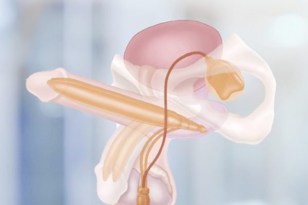 عملية دعامة القضيب