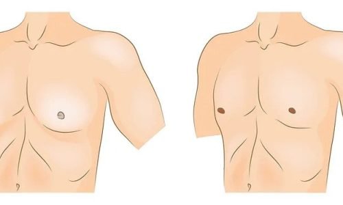 التثدي عند الرجال