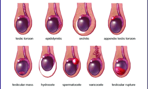 تكتلات كيس الصفن: هل هي سرطانية دائماً؟ أسباب وعلاج كتل كيس الصفن