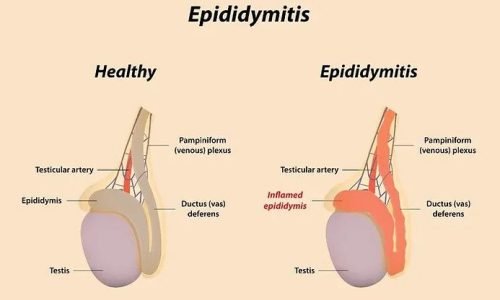 epididymitis