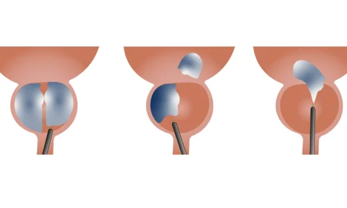 التقشير بالليزر